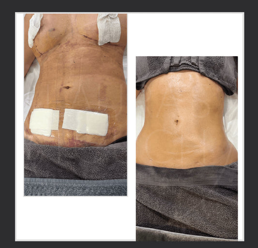 360 LYMPHATIC DRAINAGE - POST SURGICAL (1 HOUR X 10) FROM £550