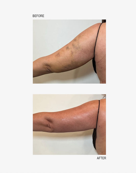 ARMS LYMPHATIC DRAINAGE (ADD ON) 30MINS £30