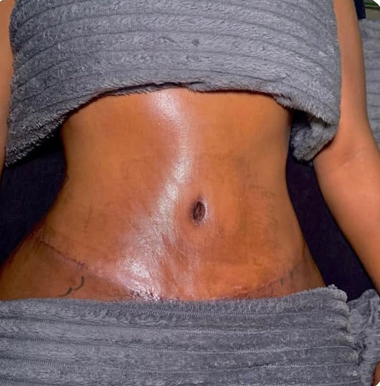 360 LYMPHATIC DRAINAGE - POST SURGICAL (1 HOUR) X6 £300