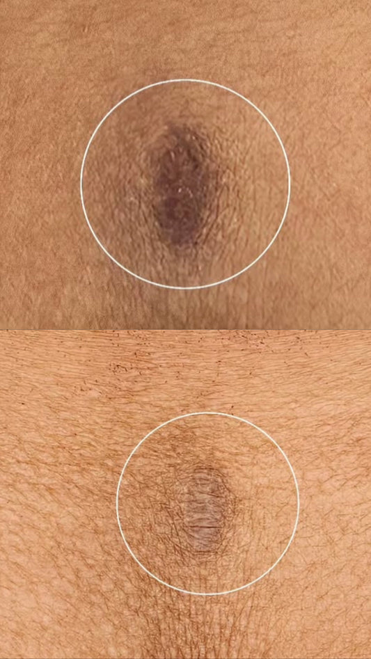 SCAR CAMOUFLAGE - LIPO SCARES