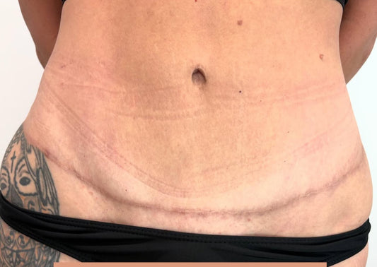 SCAR CAMOUFLAGE - TUMMY TUCK