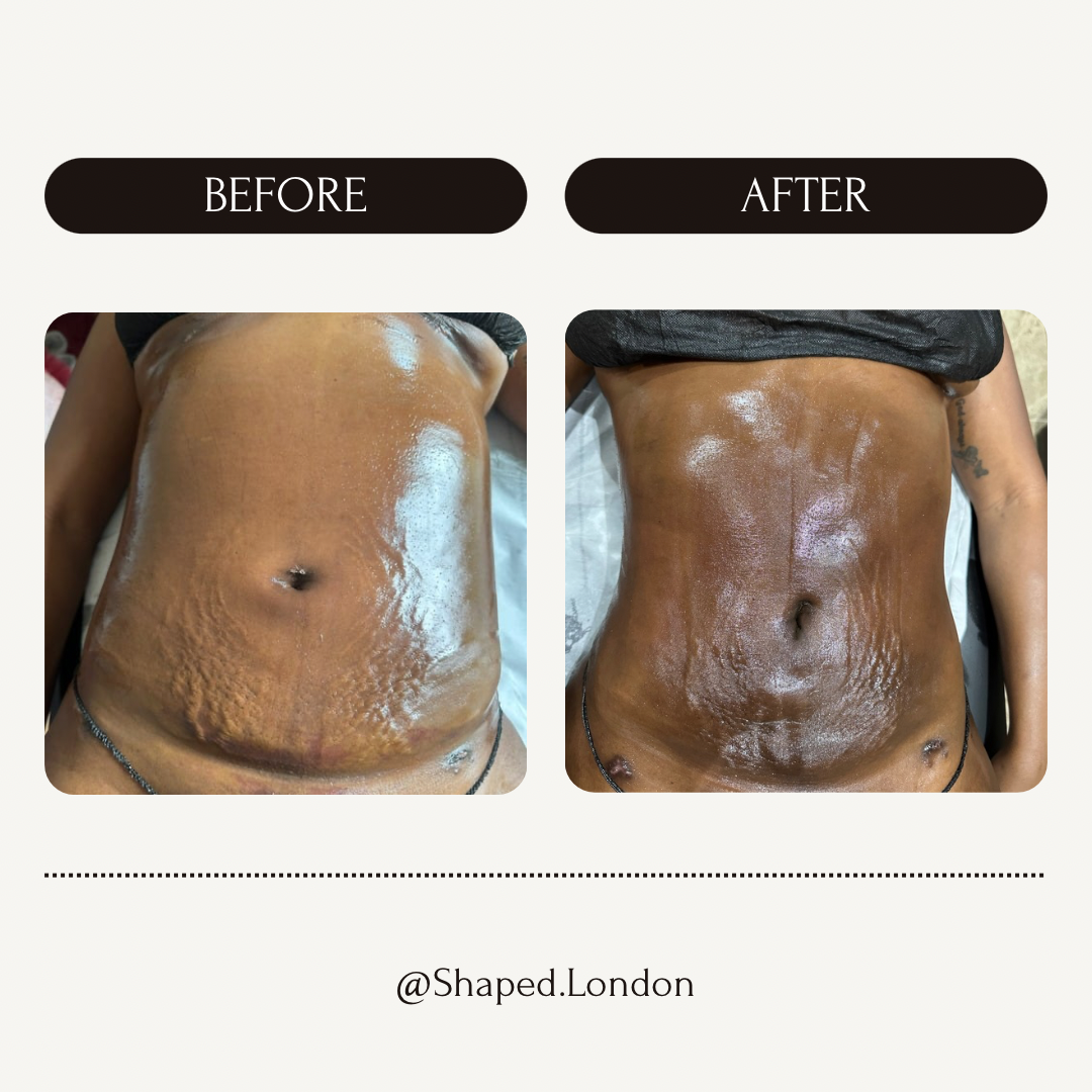 360 LYMPHATIC DRAINAGE - POST SURGICAL (1 HOUR) X6 £300