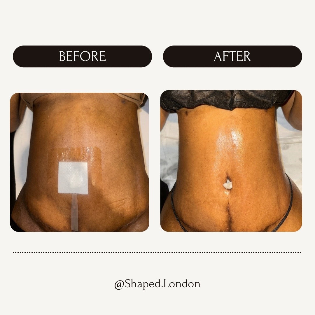 360 LYMPHATIC DRAINAGE - POST SURGICAL (1 HOUR) £55